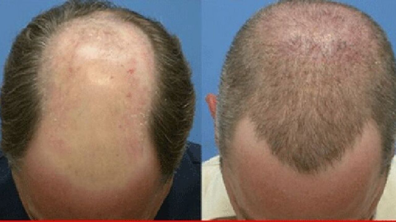 Kök hücre yöntemi saç dökülmesini durduruyor