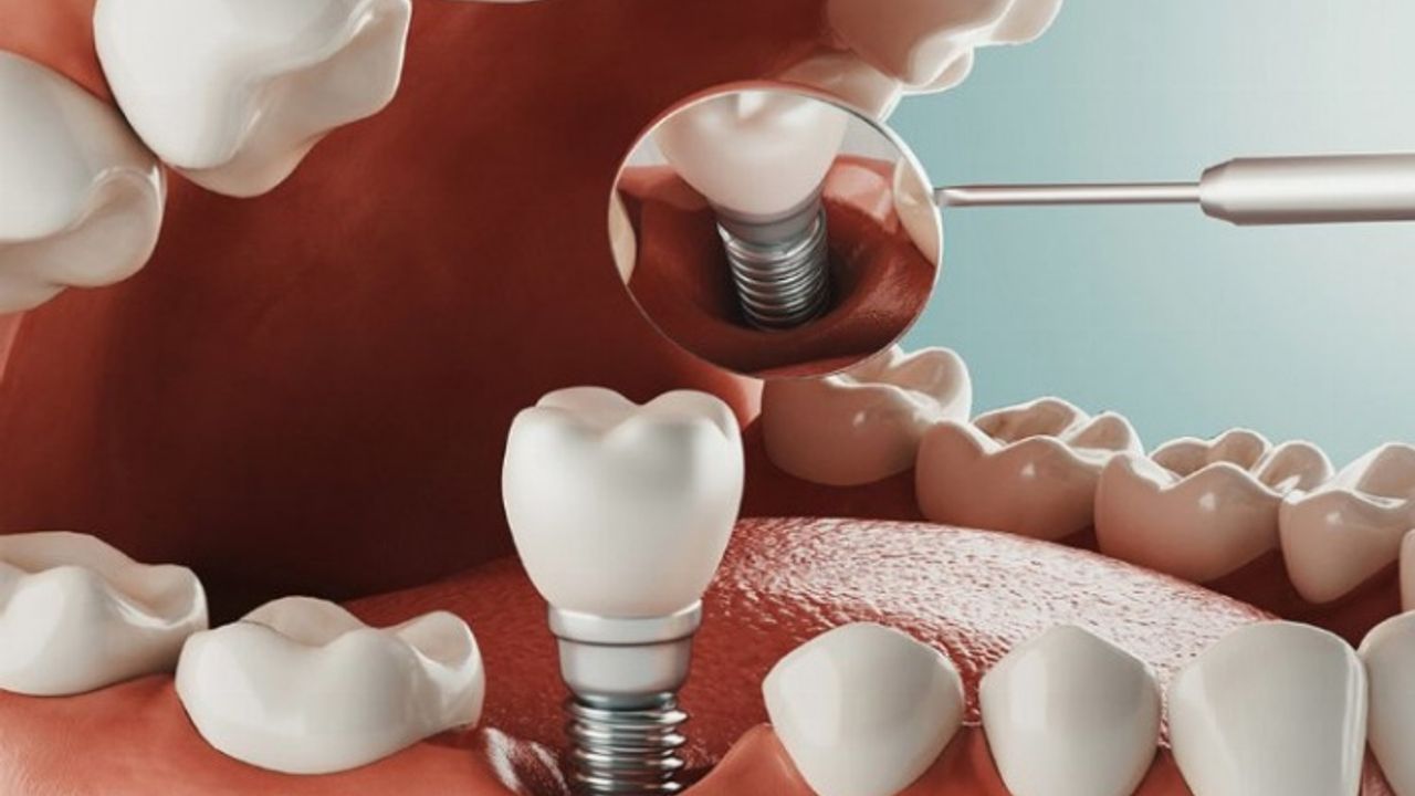 Diş tedavisinde implant zorlu bir süreç mi?
